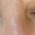 Mole on eyelid removal