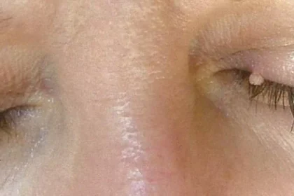 Mole on eyelid removal