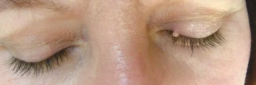 Mole on eyelid removal