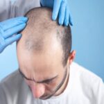 Hair Transplant in Abu Dhabi: A Comprehensive Guide to the Procedure