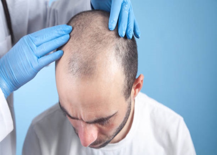 Hair Transplant in Abu Dhabi: A Comprehensive Guide to the Procedure